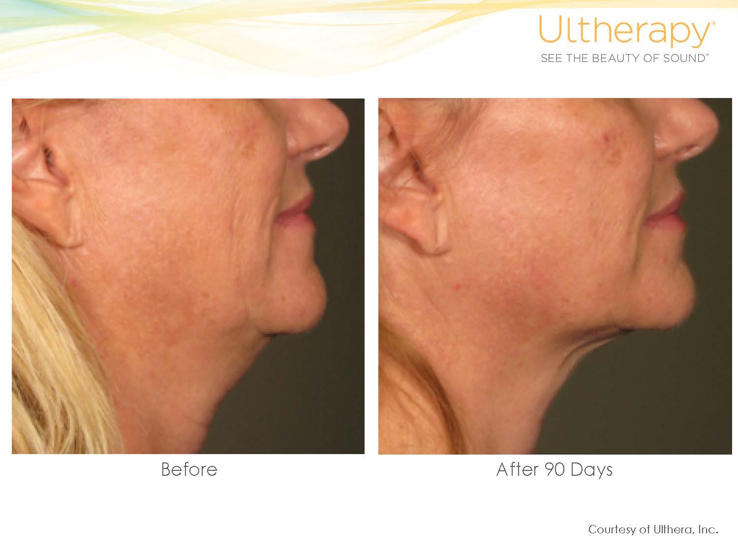 Ulthera-Before-and-Afters_Page_054