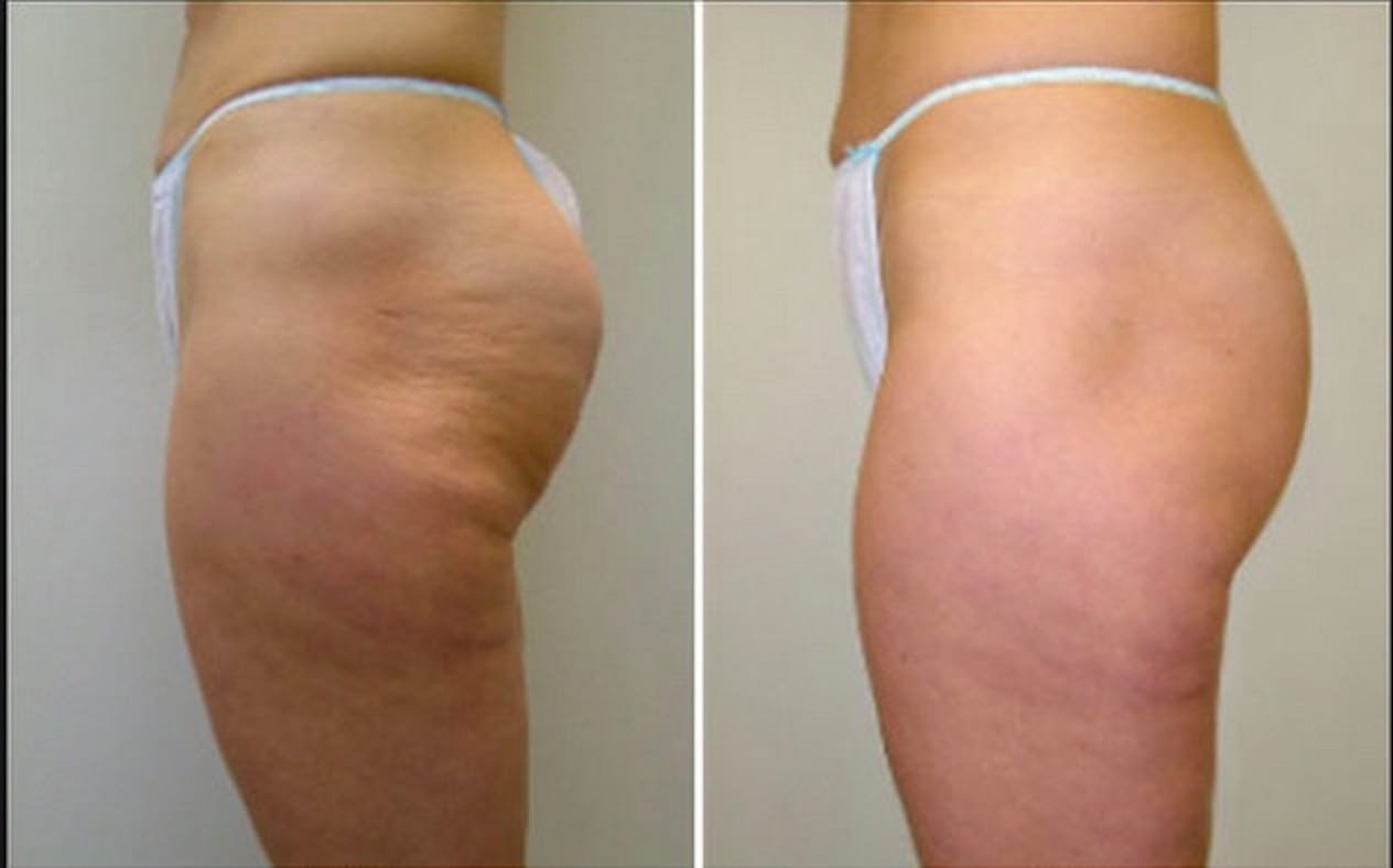 Before and After 3 treatments with Velashape 3