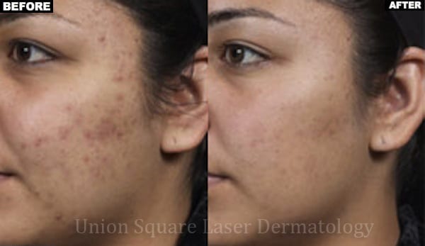 Facial Acne after six treatments with Isolaz