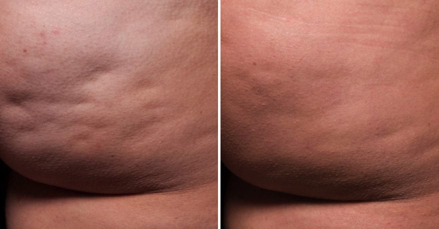 36 year old female patient treated for cellulite on buttocks; 164lbs before and 163lbs one year after a single treatment.