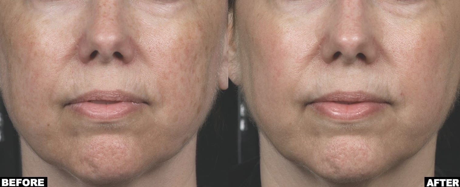 Face treatment with Clear and Brilliant laser