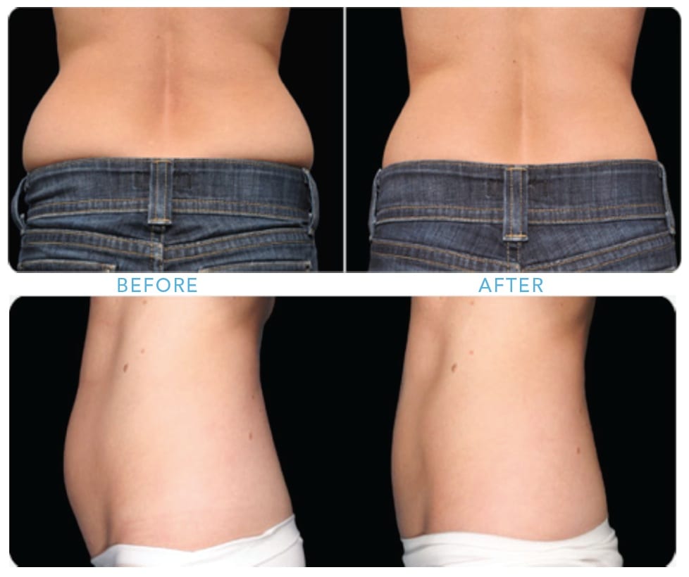 Coolsculpting in flanks and abdominal area, female patient, before treatment and after 8 weeks