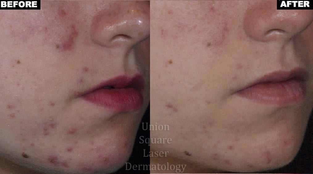 Facial Acne after one treatment with Photodynamic Therapy