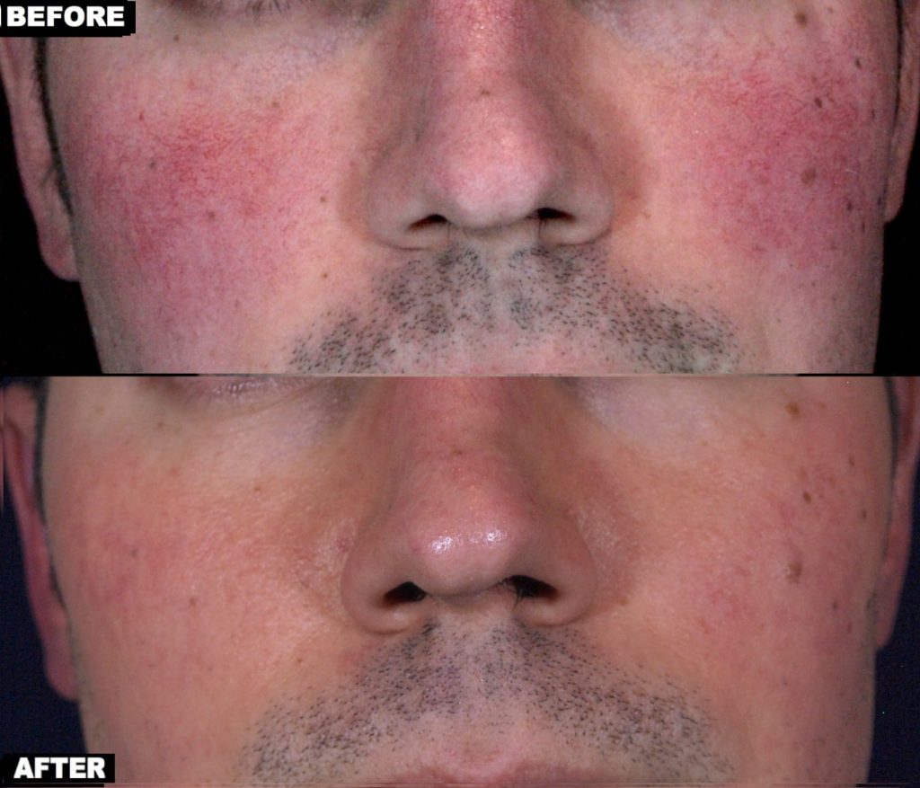Facial redness treatment with Excel V and V-Beam Lasers by Dr. Chapas (one session)