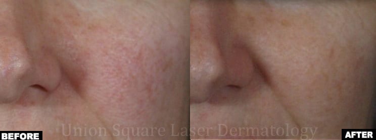 Facial redness treatment with Excel-V and V-Beam Lasers (one session)