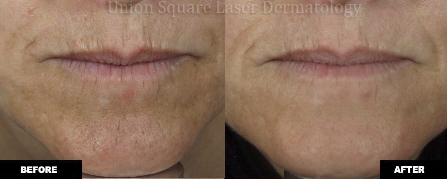 Treatment of fine lines around lips with Fraxel Restore Dual (one treatment)
