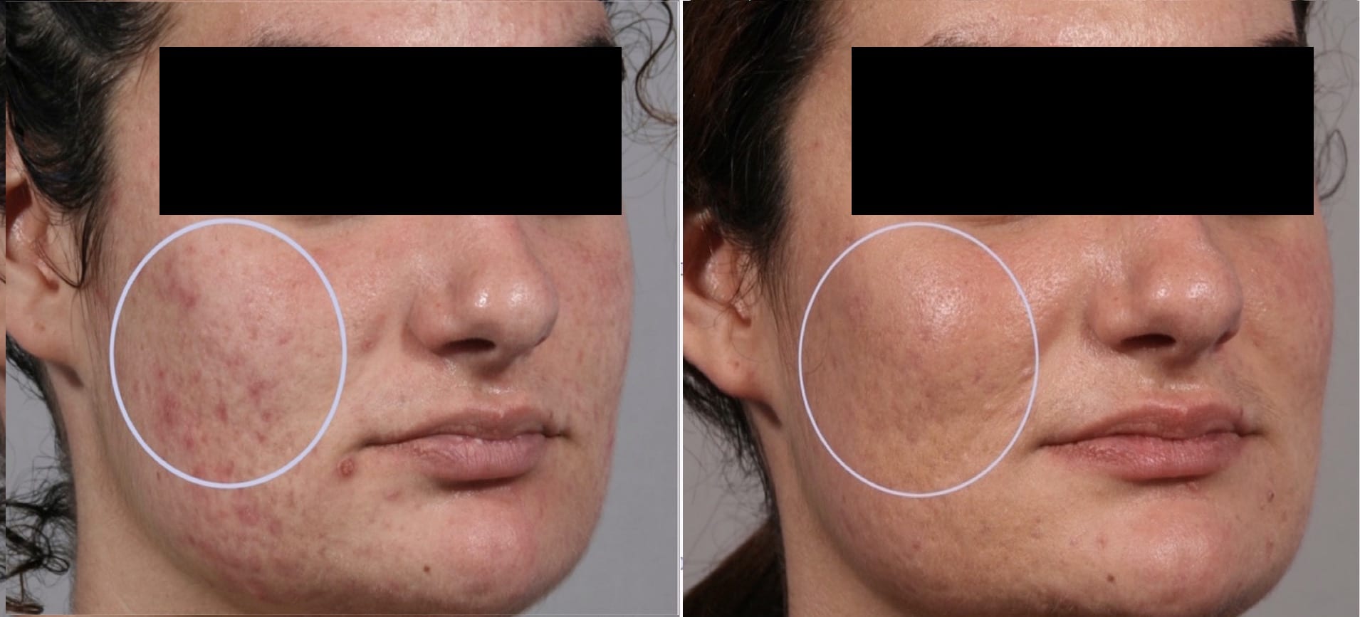 25 year old patient before treatment and 2 weeks after 3 Intensif RF Microneedle treatments for acne scars.