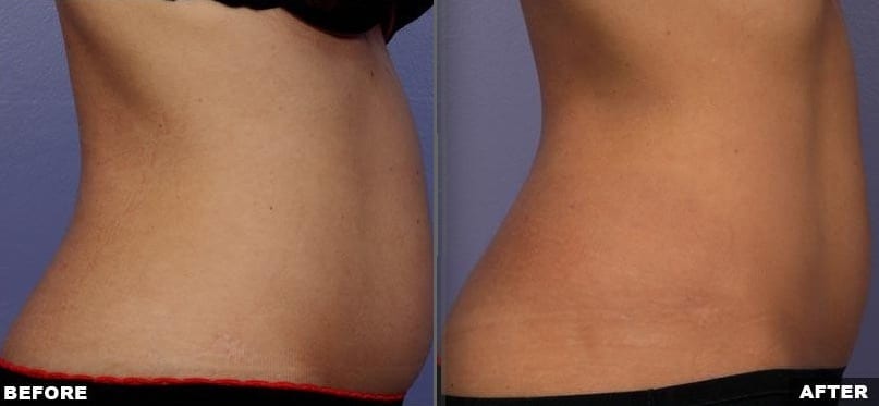 Liposonix treatment before and after side view