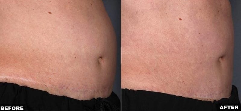 Liposonix treatment before and after quarter view