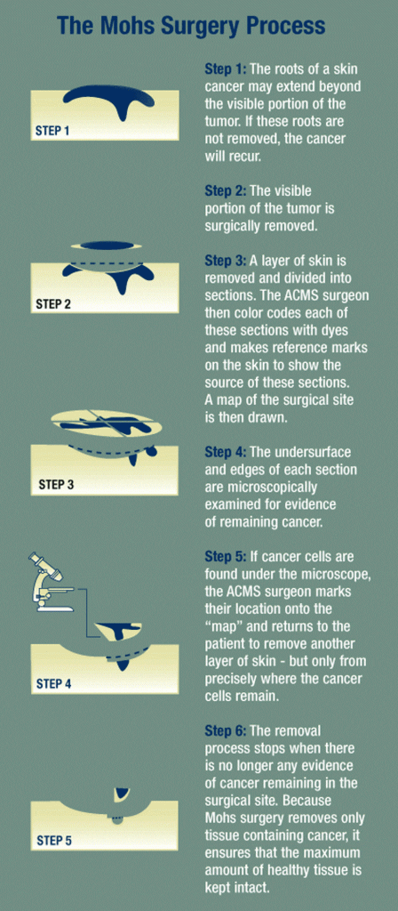Mohs Surgery Process