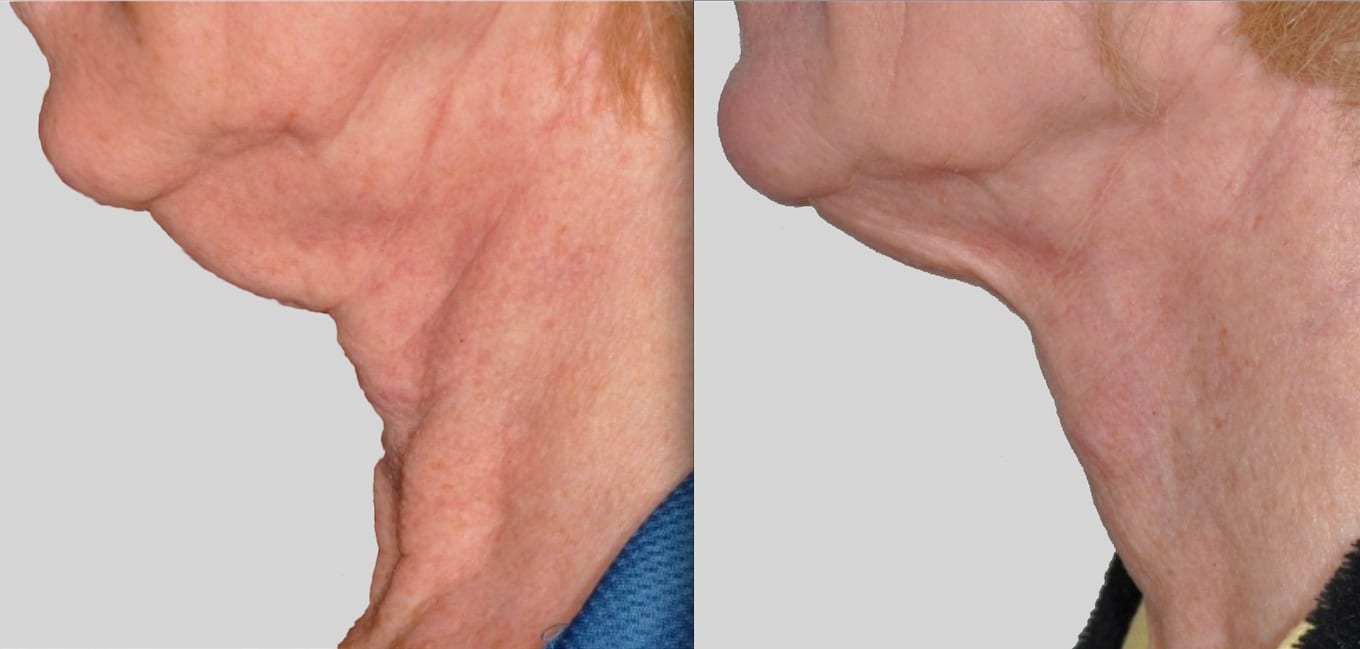 Protégé Elite photos, Before treatment and 2 months After series of treatments for submental skin tightening