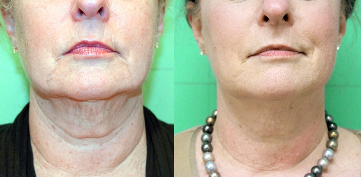 Before treatment and 2 months After series of treatments for facial skin tightening