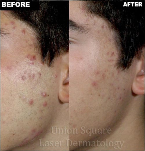 Facial Acne before and after two treatments with Smoothbeam