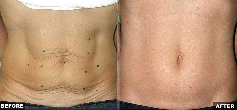 Thermage abdominal skin laxity treatment before and after photos