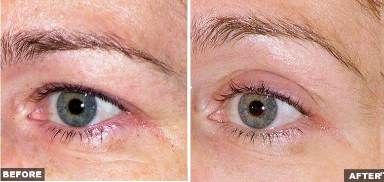 Thermage upper eyelid skin laxity treatment before and after photos