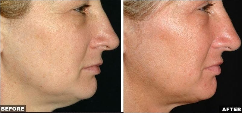 Thermage facial skin laxity treatment before and after photos