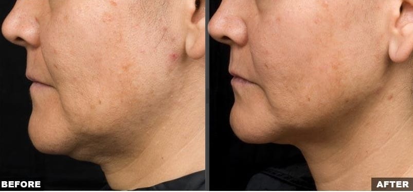 Thermage jowl skin laxity treatment before and after photos