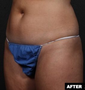 Before and After photos for abdominal treatment with truSculpt: