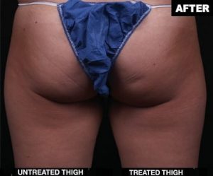 Before and After contours for right thigh truSculpt treatment