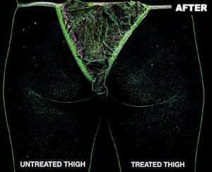 trusculpt-one-thigh-after-silhouette