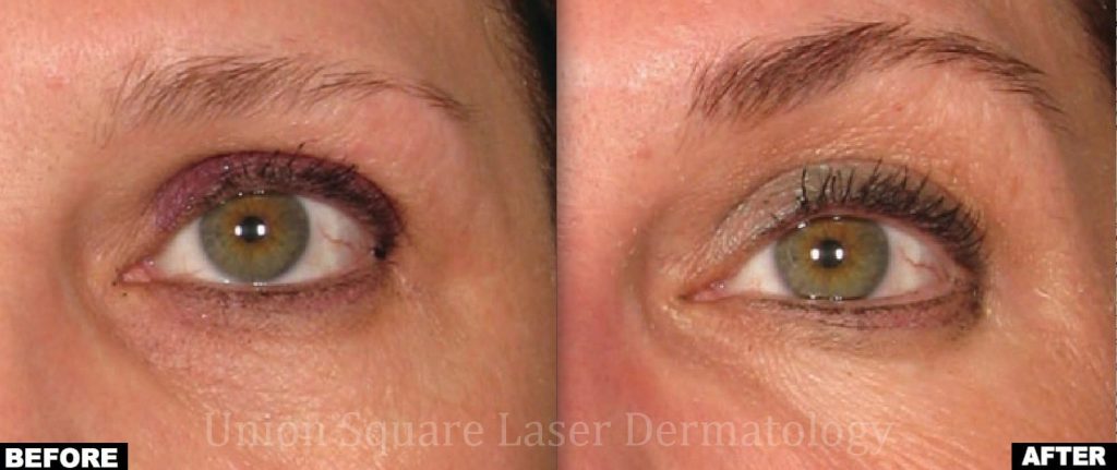 Ultherapy brow lift before and after photos