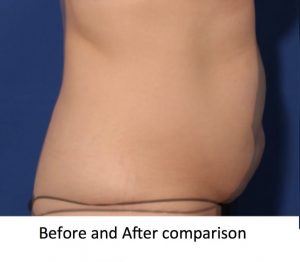 The Ultrashape Power system is an FDA-cleared technology designed to noninvasively remove stubborn fat in the abdominal (stomach and belly) area and also in the hips and thighs. The treatment is typically very well tolerated with no expected downtime. Results can be seen within several weeks, however optimal results normally are achieved after a series of three treatments spaced approximately two weeks apart. Our Assessment: We are very excited to have UltraShape as the latest addition to our body contouring arsenal. Its remarkable versatility allows targeting specific areas of unwanted body fat in the abdomen, hips and thighs. As with all body contouring devices, proper patient screening is critical in achieving good results: Ultrashape works best for patients who have specific areas of persistent unwanted fat or genetically acquired problem areas. Based on our extensive experience with the device we have developed our own treatment protocols and have seen some truly remarkable results. Why choose Union Square Laser Dermatology for UltraShape? We have extensive experience with UltraShape, beginning with our participation&nbsp;in the clinical trials that led to its FDA approval. In addition, we were one of the first practices in New York to offer the device, and we have been closely working with Syneron, UltraShape's manufacturer, on refining our proprietary treatment protocols for the best results with the maximum patient comfort. In many situations UltraShape works best in combination with other treatments, and our comprehensive range of non-surgical body contouring devices and our expertise in administering these treatments allows us to design the best personalized non-surgical body contouring plan for each patient. Before and After photos for abdominal treatment with UltraShape: