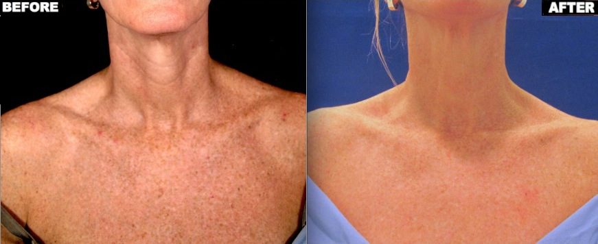 Brown spots on chest before and after one treatment with Fraxel Restore Dual laser