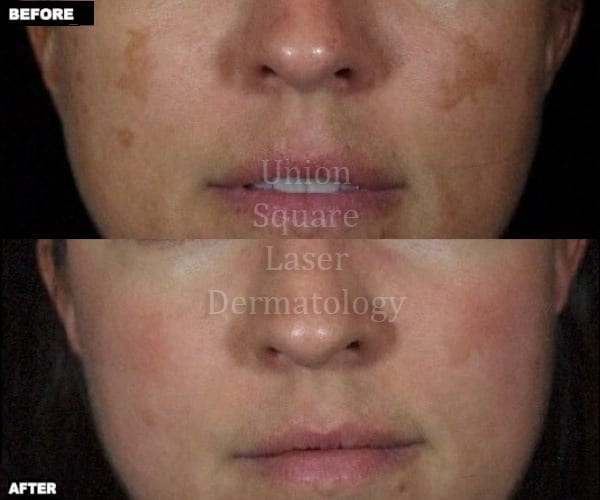 Melasma on cheeks before and after one treatment with Fraxel Restore Dual laser