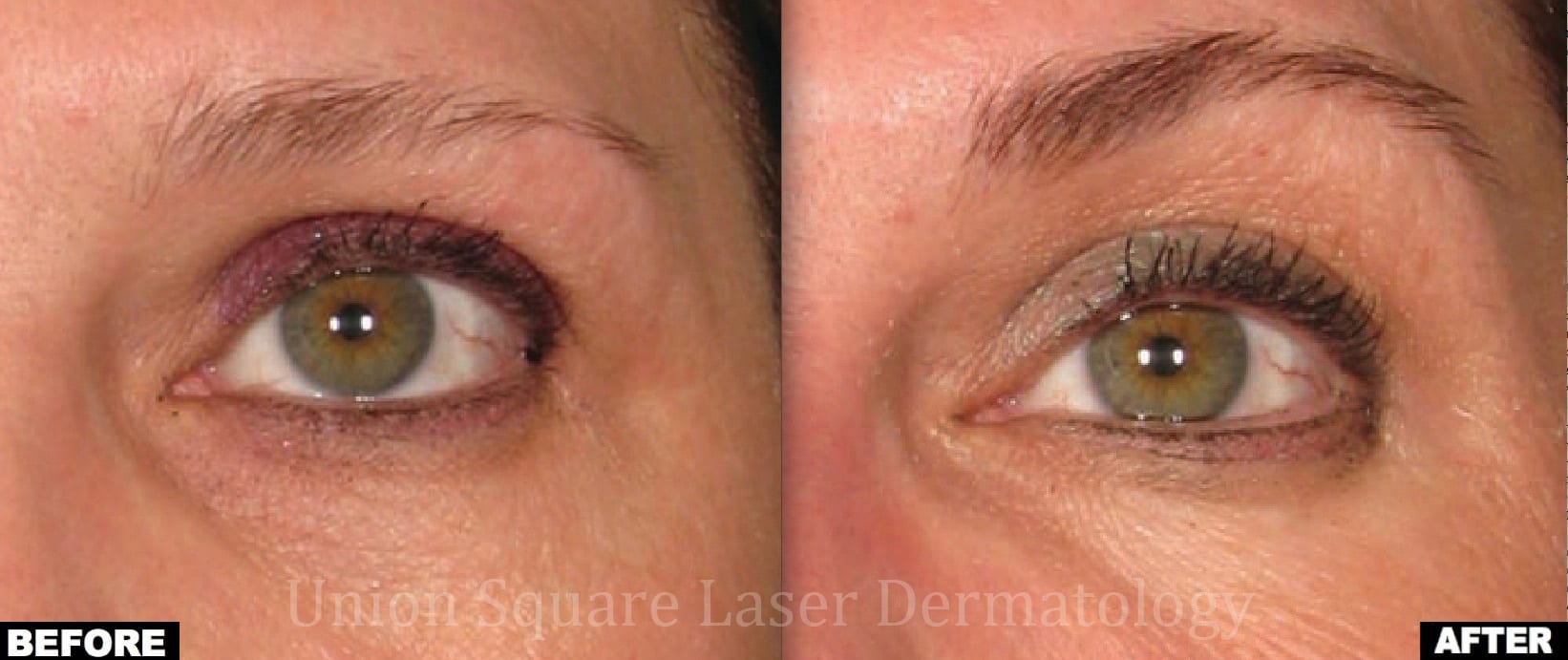 Brow lift before and after photos–Ultherapy