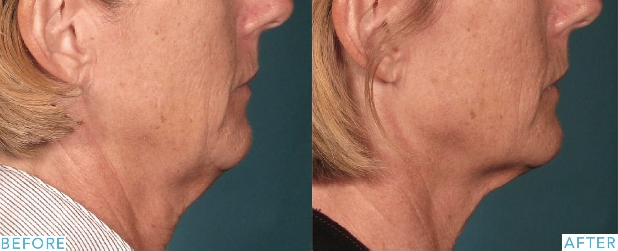  Neck skin laxity treatment before and after photos–Ultherapy